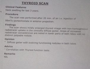 Hyperthyroidism