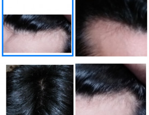 Excessive Hair Fall