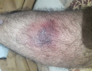 Boil On Leg Swelling Cant Close Or Turn Leg 