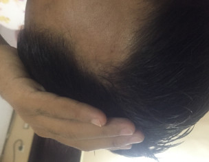 Hair Fall Issue 