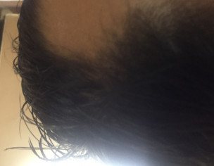 Hair Fall Issue 