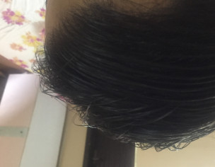 Hair Fall Issue 