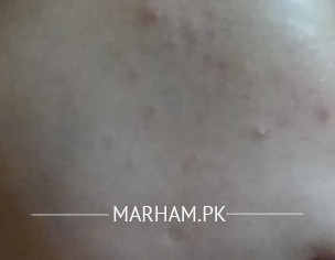 Pimples ND Scars