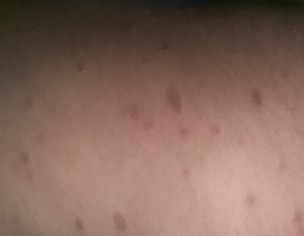 Skin Infection Psoarisis