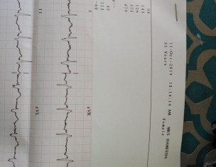 ECG Findings RBBB