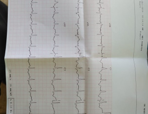 ECG Findings RBBB