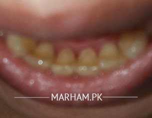 Teeth Problem
