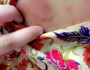 Skin Allergy/rashes