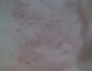 Microneedling  
