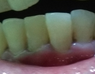 Teeth Problem 