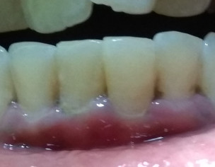 Teeth Problem 
