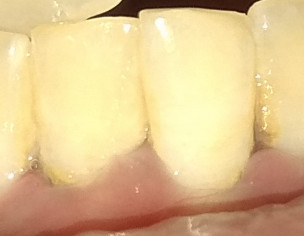 Teeth Problem 