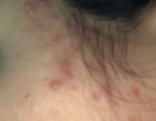 Acne Problem 