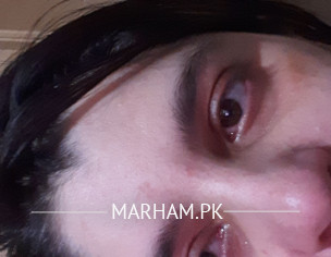 Mild Melasma