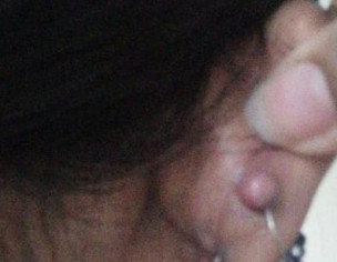 A Boil On Ear