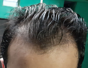 Male Patern Baldness (Alopecia)