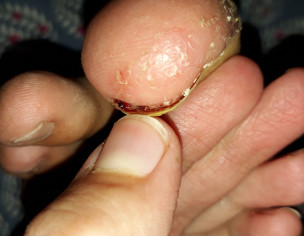 Puss Infection