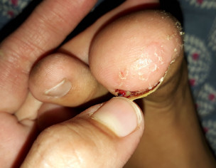 Puss Infection