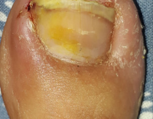Puss Infection