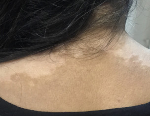 Skin Decoloration