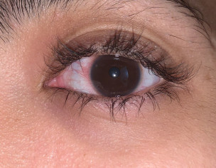Eye Redness 