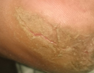  Sores Eczema 