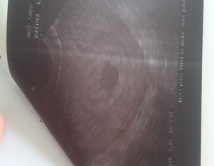 Pregnancy With No Heart Beat 