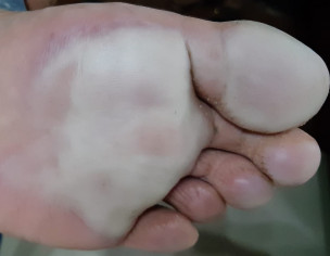 Feet Issue