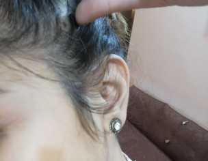 Bump On Scalp