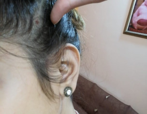 Bump On Scalp