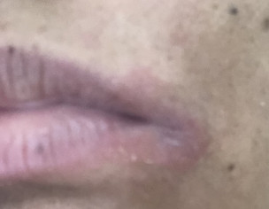 Skin Allergy  