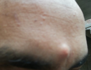 Lump On Forehead