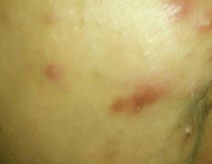 Pimples