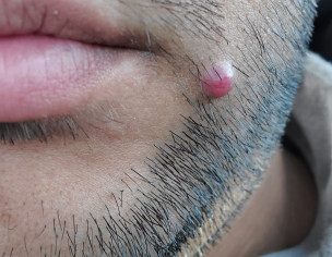 Seems Like A Pimple 