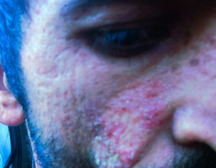 Oral And Skin 