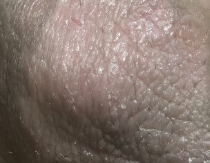 Scrotal Itching With Pink Patches