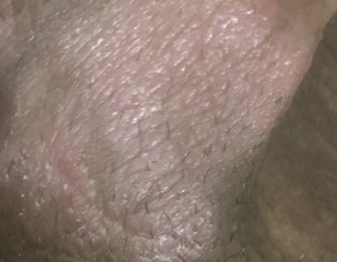 Scrotal Itching With Pink Patches