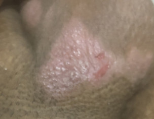 Scrotal Itching With Pink Patches