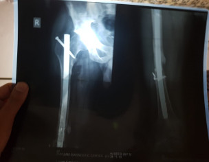 Femur Fracture 