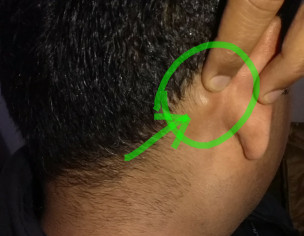 Bone Swelling Behind Right Ear