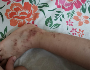Atopic Dermatitis Ezcema 