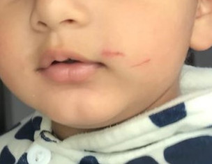 Skin Wound