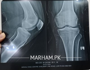 Left Knee Joint