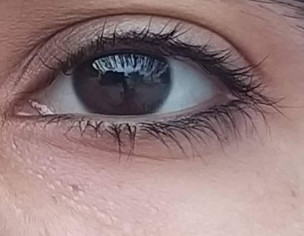 Eye Problem