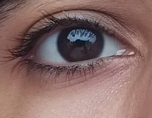 Eye Problem