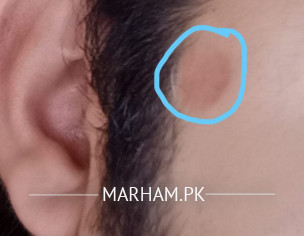 Scar On Face
