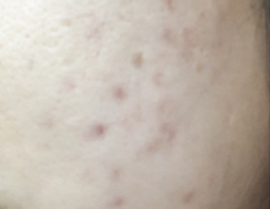 Acne Marks And Scars