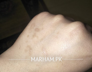 Dark Spots On Hands