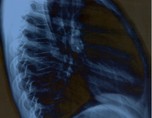 Pectus Carinatum