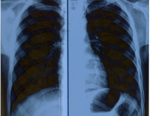 Pectus Carinatum